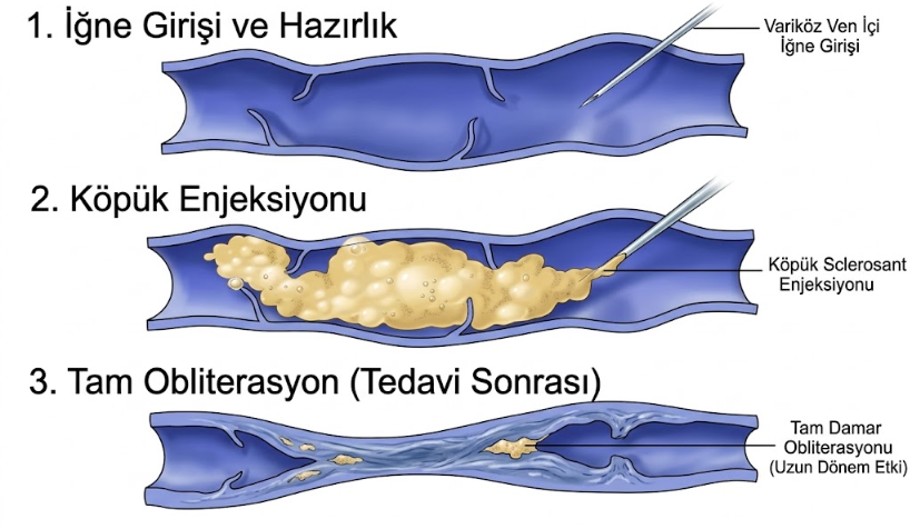 Köpük tedavisinin üç aşamasını gösteren çizim