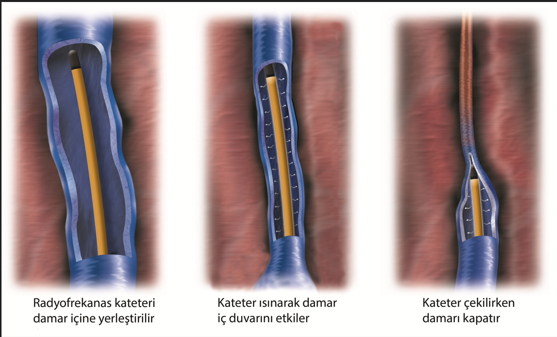 Radyofrekans kateteri ile varis tedavisi aşamaları