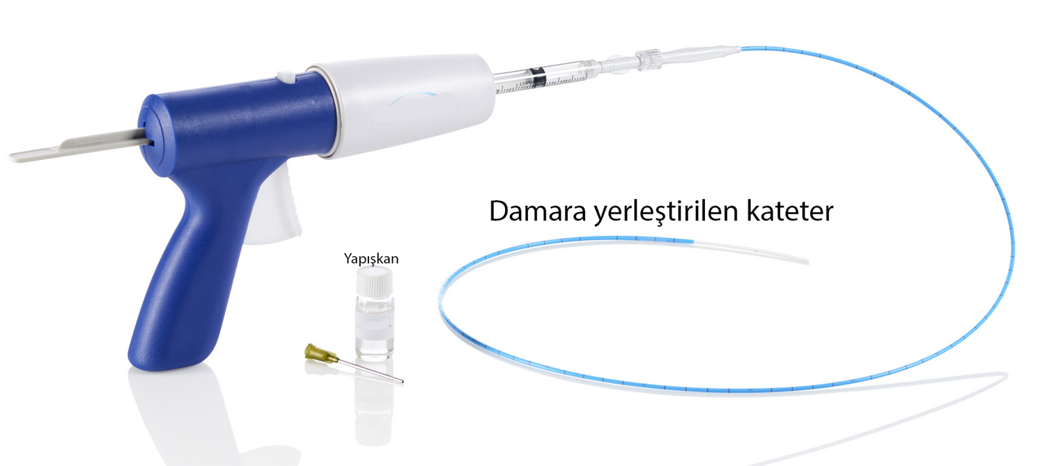 Yapışkanla varis tedavisinde kullanılan uygulama cihazı, yapışkan ve damara yerleştirilen kateter