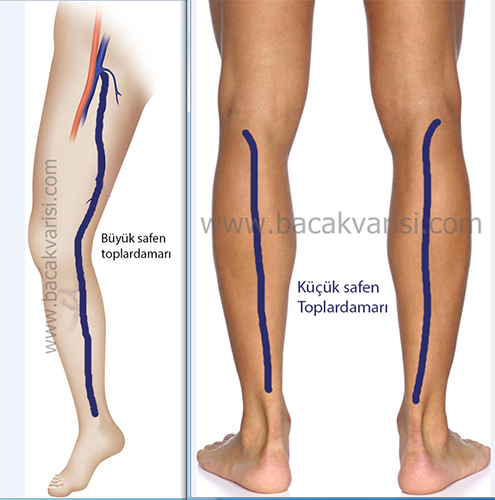 Lazerle varis tedavisinde tedavi olan damarlar 