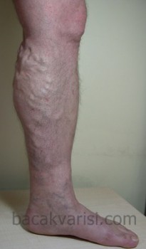 Bacaklarda büyük varisler çok sık görülen bir hastalıktır 