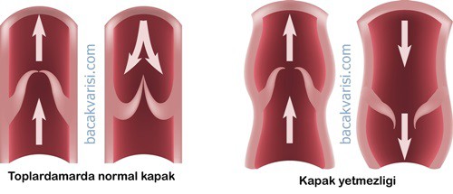 Venöz yetmezlik toplardamar kapağındaki kaçak nedeniyle olur. 